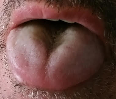 Swollen Tongue