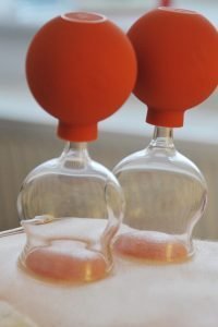Cupping uses TCM theory and demonstrates how acupuncture works