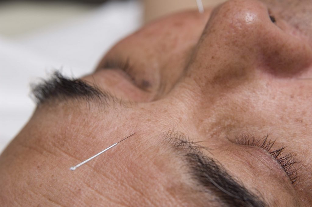 Facial Acupuncture, but other points, like Pericardium 6, are also very calming