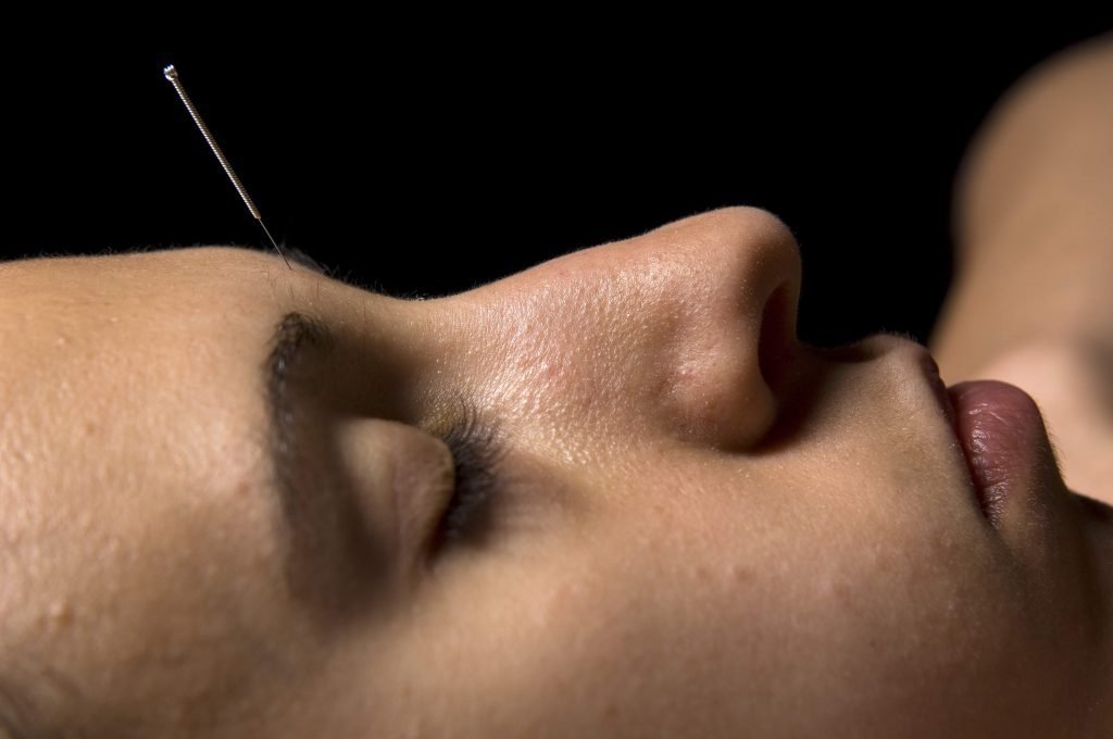 Acupuncture Forehead at Yintang to descend Shen qi and calm excess such as lung heat