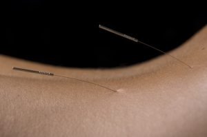 Acupuncture to support Spleen Damp Cold Treatment