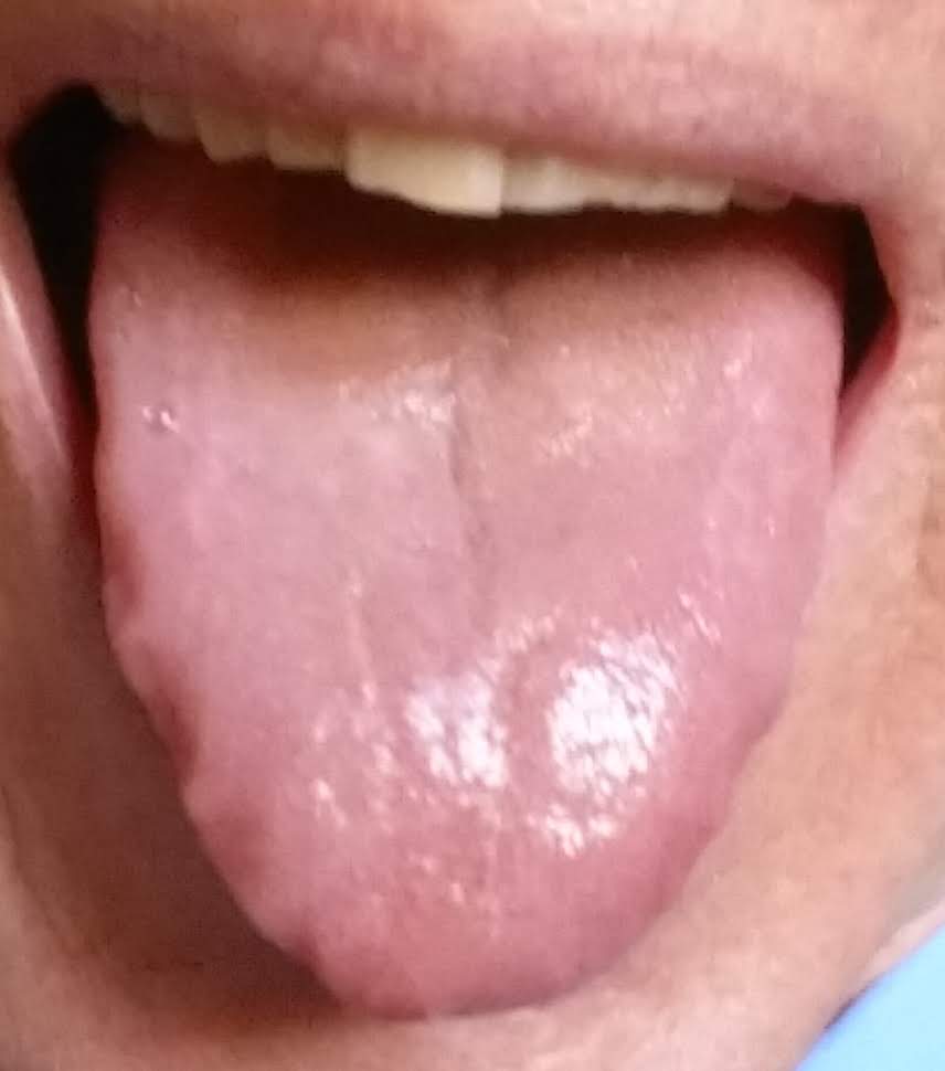 Tongue with Tooth-marks