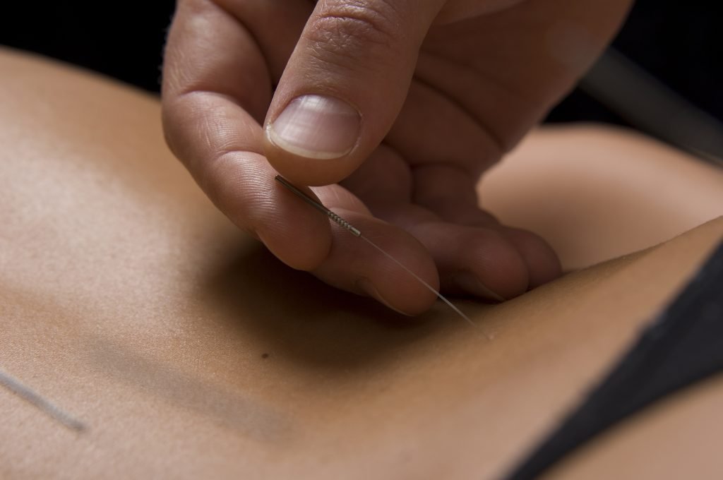 Placing an acupuncture needle in treatment for Stomach Blood stasis