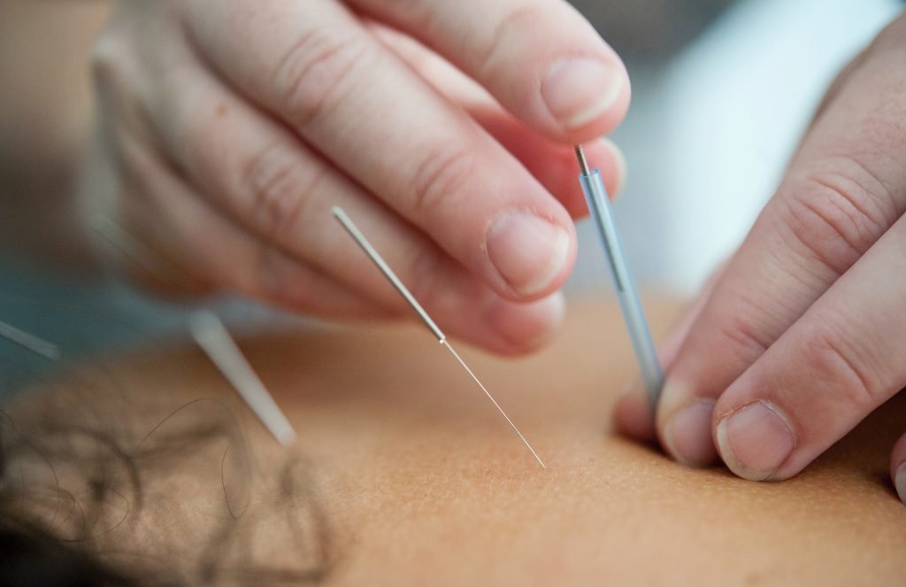 Between acupuncture and homoeopathy, here's acupuncture