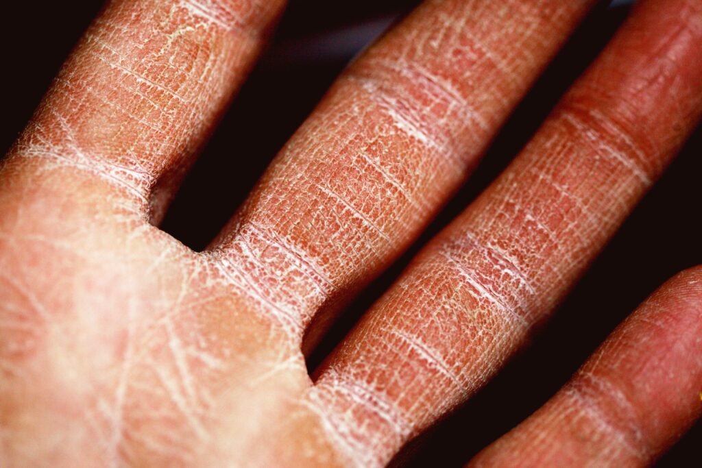 Dry skin is often a symptom of Blood deficiency